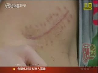 17岁高中生为买iPad2 2万元卖掉自己右肾(图)