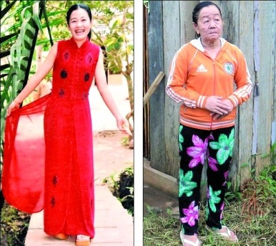 阮氏芳患病前青春靓丽,现则面如70岁老妇。小图:丈夫的关爱让阮氏芳重拾信心。