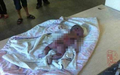 福建女婴死因非烫死 专家:或死于感染