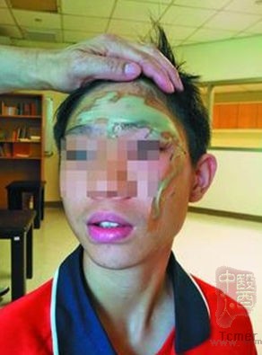 台北市内湖初中郑姓班导师误把浓硫酸当醋酸,一名女学生不慎把浓硫酸喷溅到同学,其中洪姓男学生被喷中脸、手,有部位分遭二、三级烧烫伤。来源:台湾《联合报》 台北市内湖初中郑姓班导师误把浓硫酸当醋酸,一名女学生不慎把浓硫酸喷溅到同学,其中洪姓男学生被喷中脸、手,有部位分遭二、三级烧烫伤。来源:台湾《联合报》
