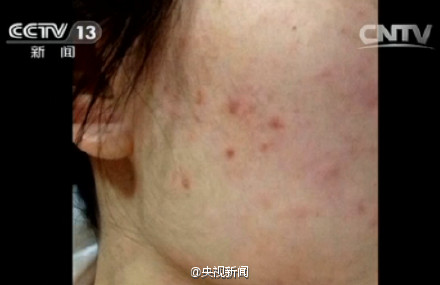 朋友圈的面膜加激素致痘 不如DIY天然面膜养肤