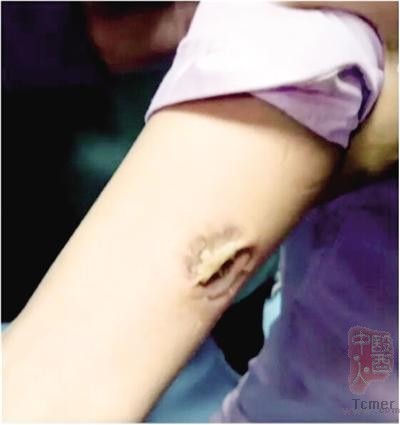 女护士手臂被患者咬住忍痛坚持 网友:看着好心疼