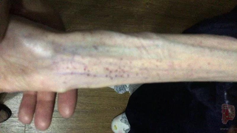 21��Ů��������50�� 2���Գ�Ѫ����֯��60��