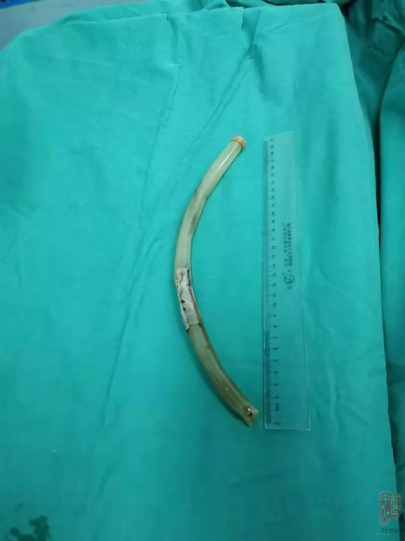 Ů������ƺ��̲��������� ҽ��ȡ��30CM�����¹�