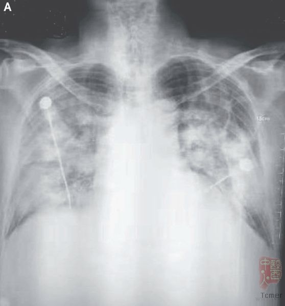 新型冠状病毒肺炎的胸部X光片 图片来源:NEJM