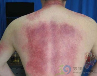 详解:刮痧拔罐全过程(图)