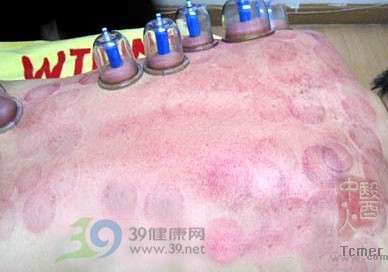 详解:刮痧拔罐全过程(图)