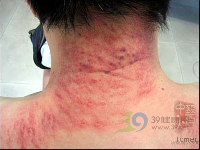 详解:刮痧拔罐全过程(图)